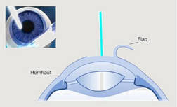 Schleifen der Hornhaut mit dem Excimer-Laser
