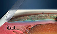 Minimal- invasive Glaukom-Chirurgie (MIGS)