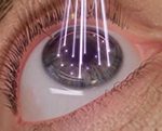 Link zu Augen-Laser-Chirurgie