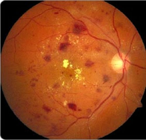 retinopathia diabetica e10 e14)